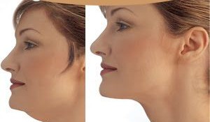 How to Lose Double Chin Fat