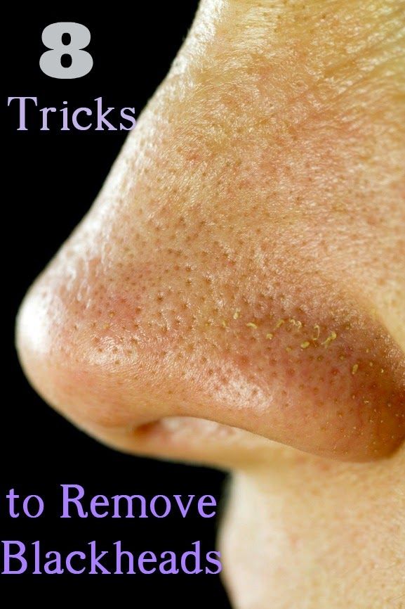 Natural remedies to Get rid of Blackheads