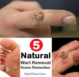 5 Natural Wart Removal Home Remedies