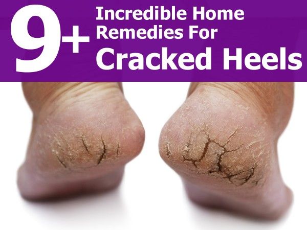9 Home remedies for cracked heels