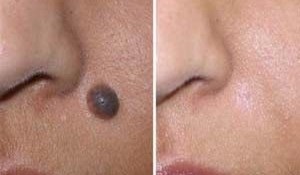 Home Remedies to Cure Moles