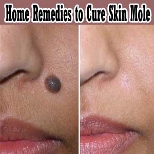 Home Remedies to Cure Moles