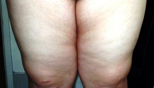 How you can Get Rid Of Inner Thigh Fat