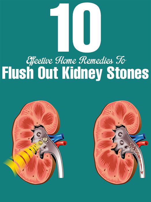 Top 10 Effective Home Remedies To Flush Out Kidney Stones