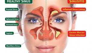 DIY Home remedies for the treatment of Sinus infection.