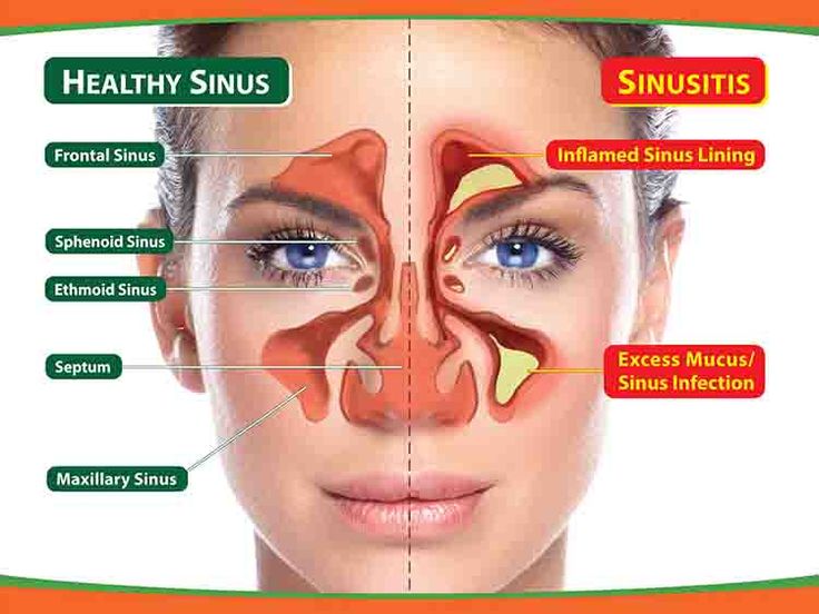 DIY Home remedies for the treatment of Sinus infection.