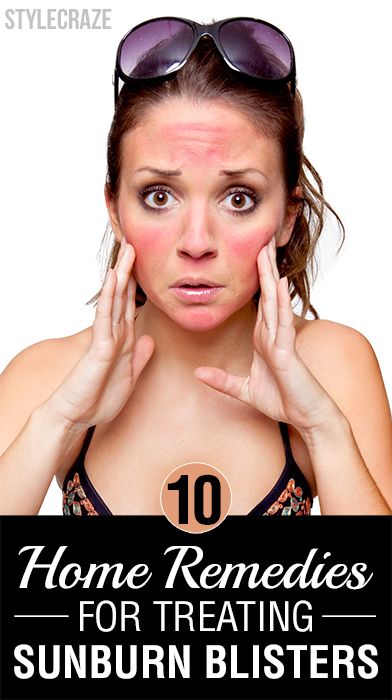 Top 10 Effective Home Remedies For Treating Sunburns Blisters