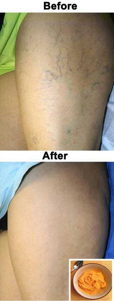  The Most Effective Natural Treatment For Varicose Veins 