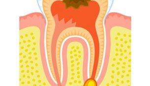 26 Effective Home Remedies For Cavities