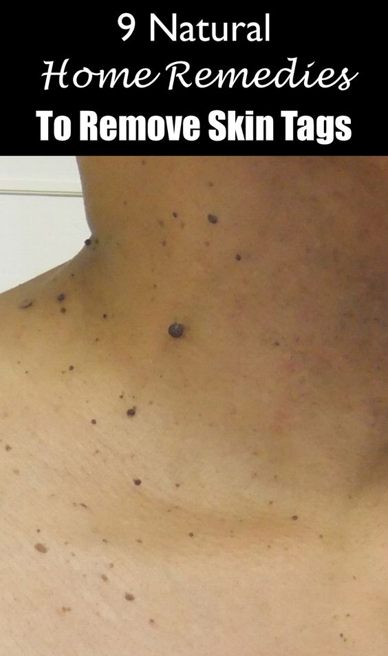  9 Natural Home Remedies To Remove Skin Tags 