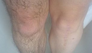 1Tbsp of iodine 2% 1Cup of baby oil Rub your hairy area with the mixture and let set for only 5 minutes