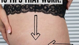 How to Get Rid of Cellulite 10 Natural Remedies That Work