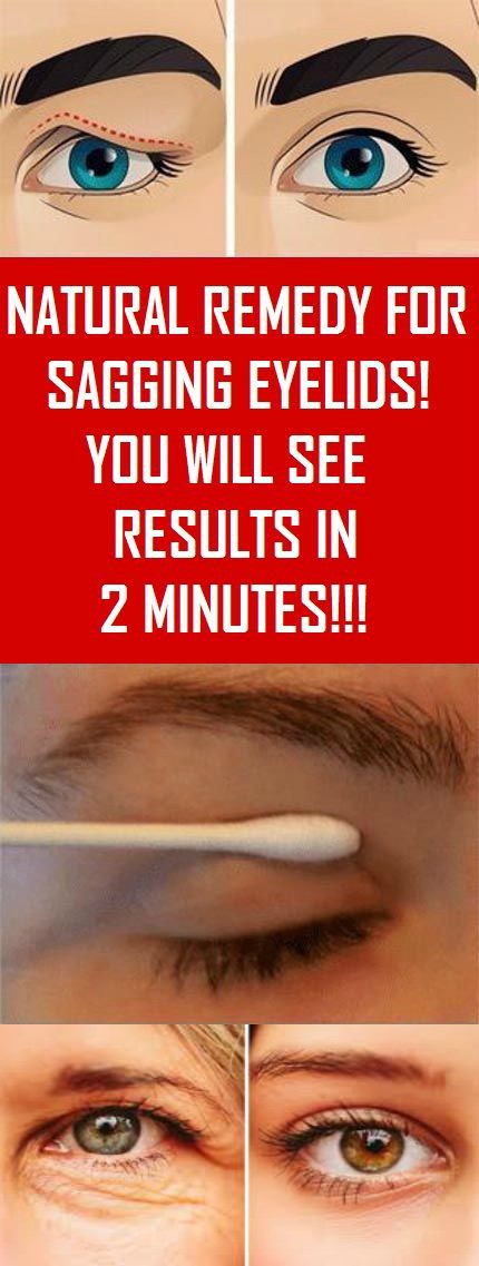 Natural Remedy For Sagging Eyelids You Will See Results In 2 Minutes!