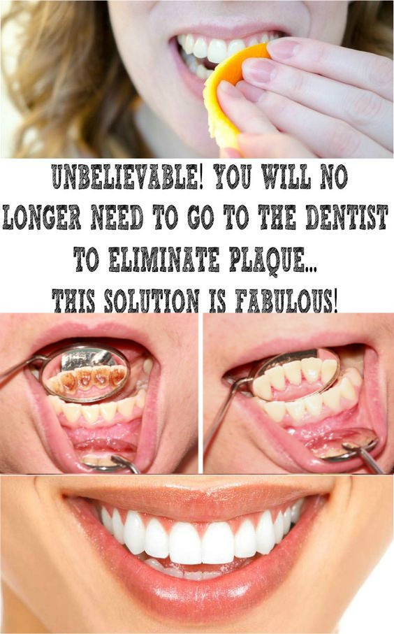 UNBELIEVABLE! YOU WILL NO LONGER NEED TO GO TO THE DENTIST TO ELIMINATE PLAQUE… THIS SOLUTION IS FABULOUS!