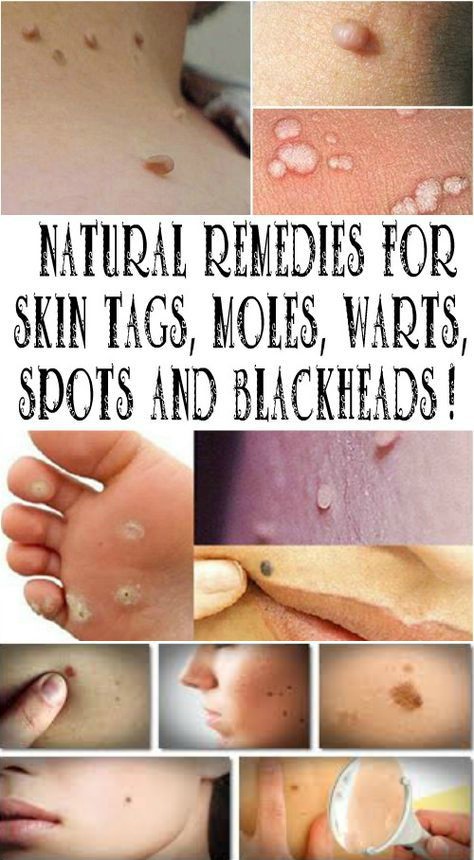 NATURAL REMEDIES FOR SKIN TAGS, MOLES, WARTS, SPOTS AND BLACKHEADS!