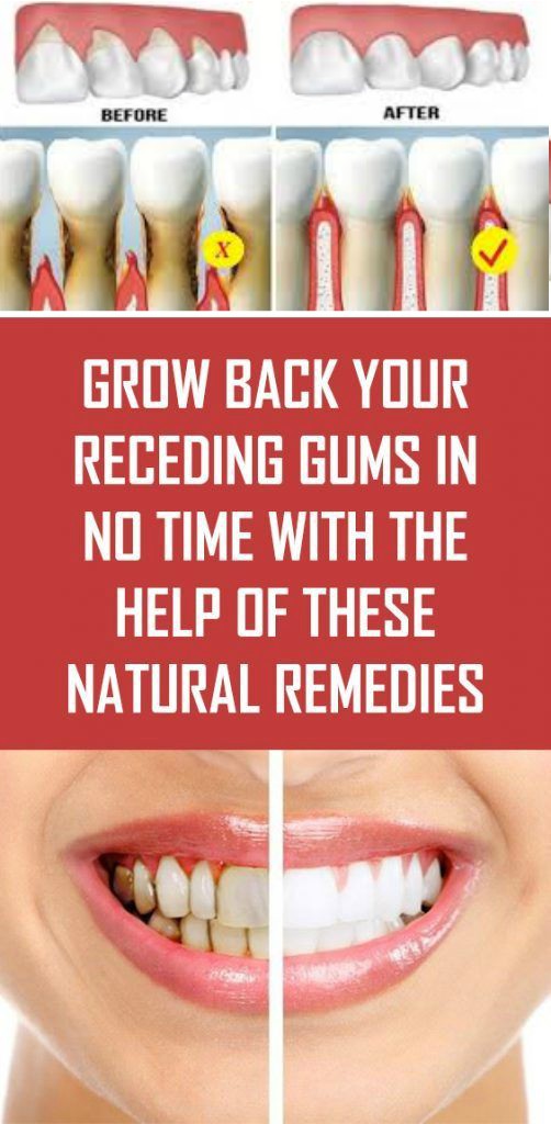 Grow Back Your Receding Gums In No Time With The Help Of These Natural Remedies