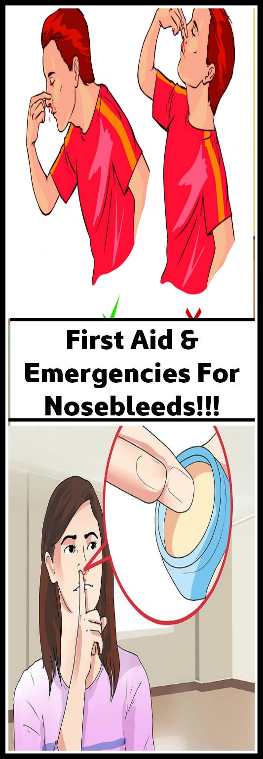 First Aid & Emergencies For Nosebleeds!!!