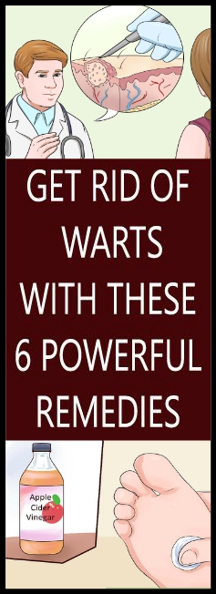 GET RID OF WARTS WITH THESE 6 POWERFUL REMEDIES - Copy
