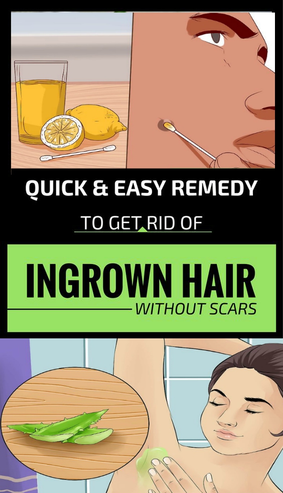 Quick & Easy Remedy To get Rid Of Ingrown Hair Without Scars!!!