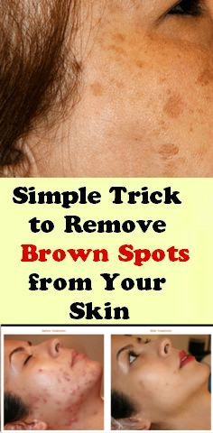 Simple Trick to Remove Brown Spots from Your Skin