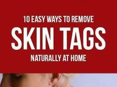 How to Remove Skin Tags Naturally at Home?
