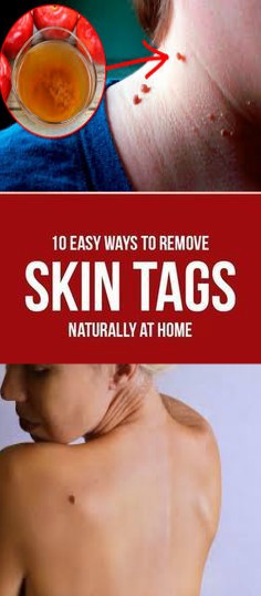 How to Remove Skin Tags Naturally at Home?