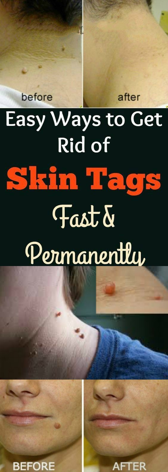 How to Remove Skin Tags Fast: 8 Home Remedies That Really Work
