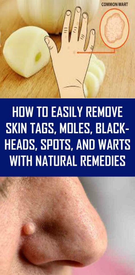 How to Easily Remove Skin Tags, Moles, Blackheads, Spots, and Warts with Natural Remedies
