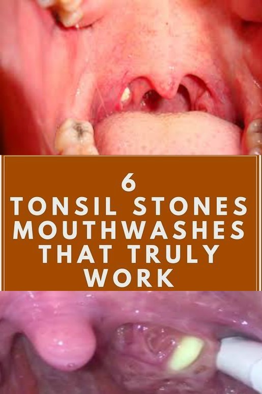 how to get rid of tonsil stones