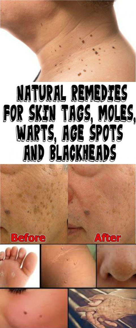 NATURAL REMEDIES FOR SKIN TAGS, MOLES, WARTS, AGE SPOTS AND BLACKHEADS