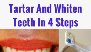 A Friend Dentist Taught Me How To Remove Tartar And Whiten Teeth In 4 Steps