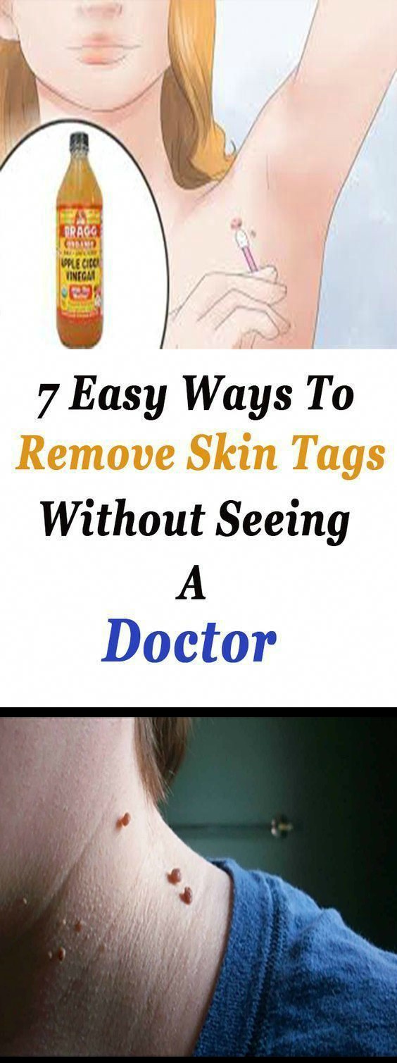 7 Easy Ways To Remove Skin Tags Without Seeing A Doctor