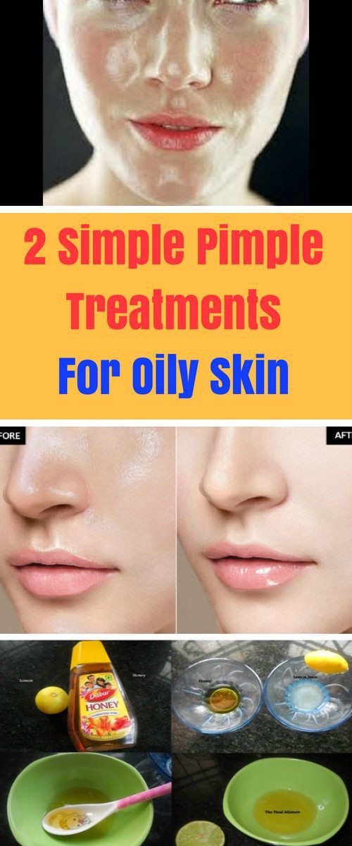 2 Simple Pimple Treatments For Oily Skin