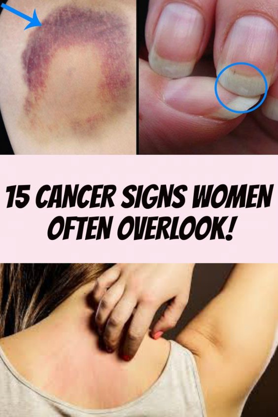 15 CANCER SIGNS WOMEN OFTEN OVERLOOK!