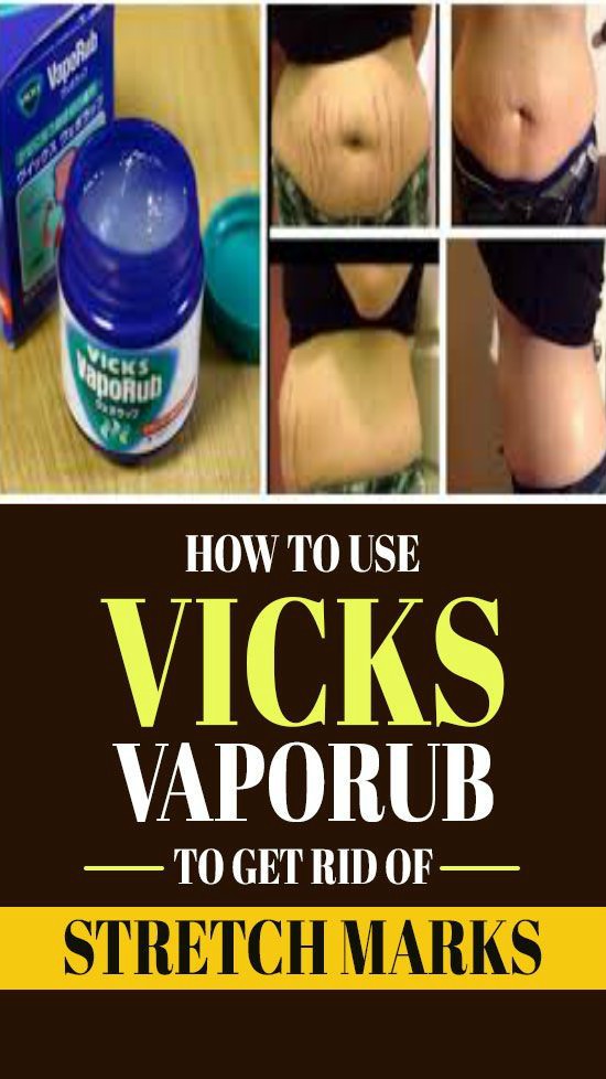 How To Use Vicks VapoRub To Get Rid Of Stretch Marks?