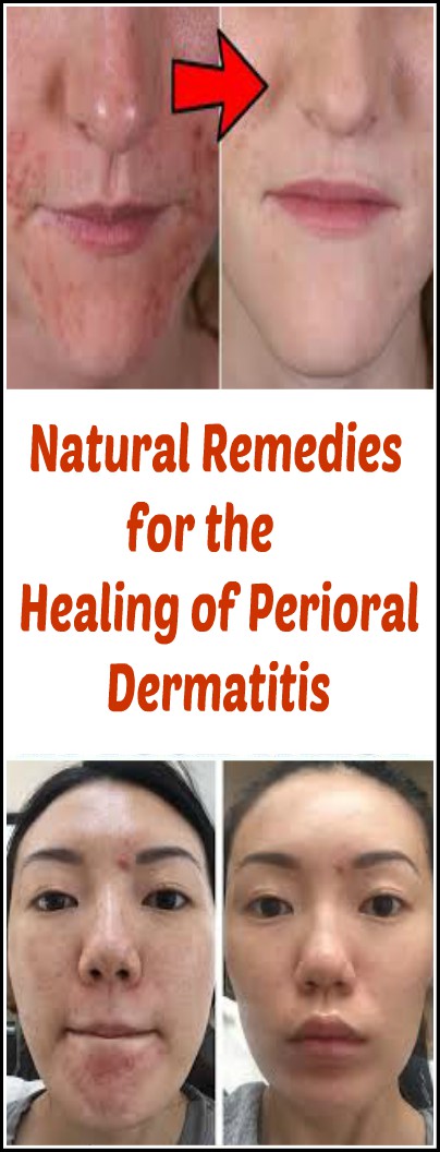 Natural Remedies for the Healing of Perioral Dermatitis