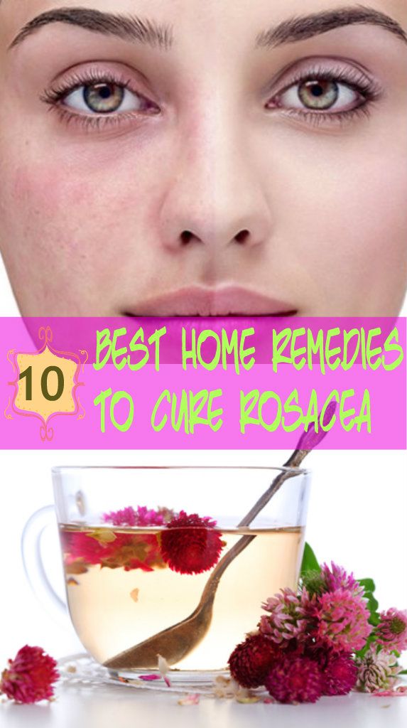 10 Best Home Remedies to Cure of Rosacea
