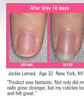 Real results from a nail growth treatment called GO Nails
