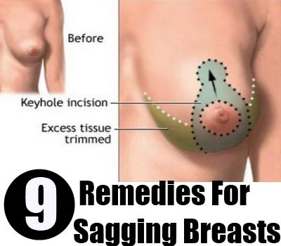9 Remedies For Sagging Breasts