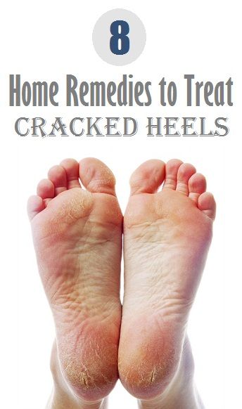 Top 8 Home Remedies to Treat Cracked Heels