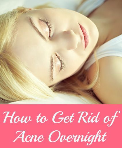 How to Get Rid of Acne Overnight