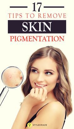17 Tips To Remove Skin Pigmentation