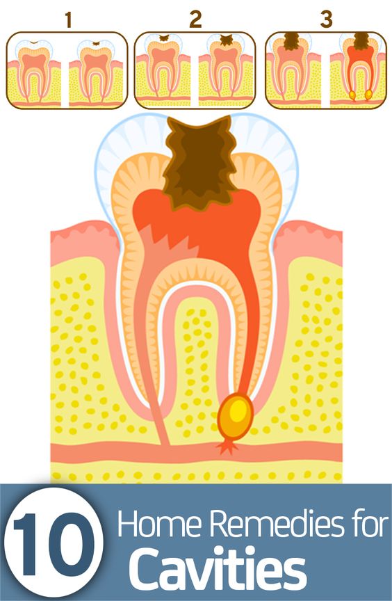 26 Effective Home Remedies For Cavities 26 Effective Home Remedies For Cavities