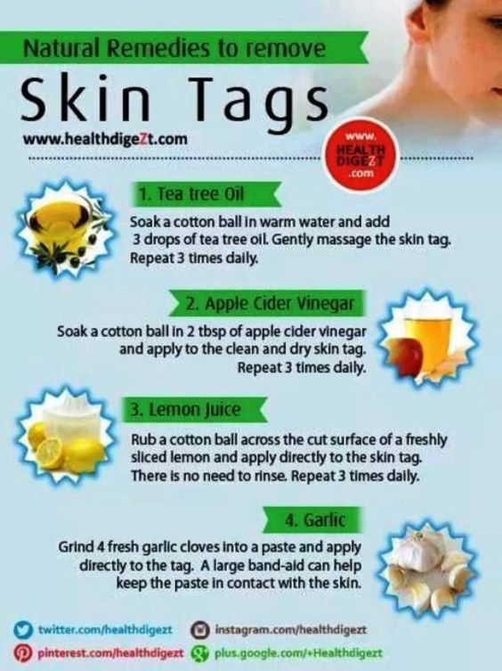 How to Remove Skin Tags Yourself Naturally