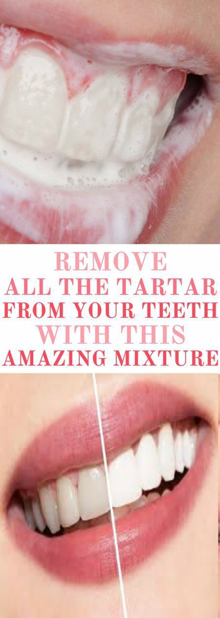 Try This Amazing Mixture And Remove All the Tartar From Your Teeth