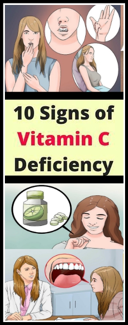 10 Signs Of Vitamin “C” Deficiency!!!