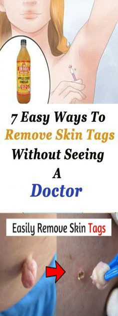 7 easy ways to remove skin tags without seeing a doctor