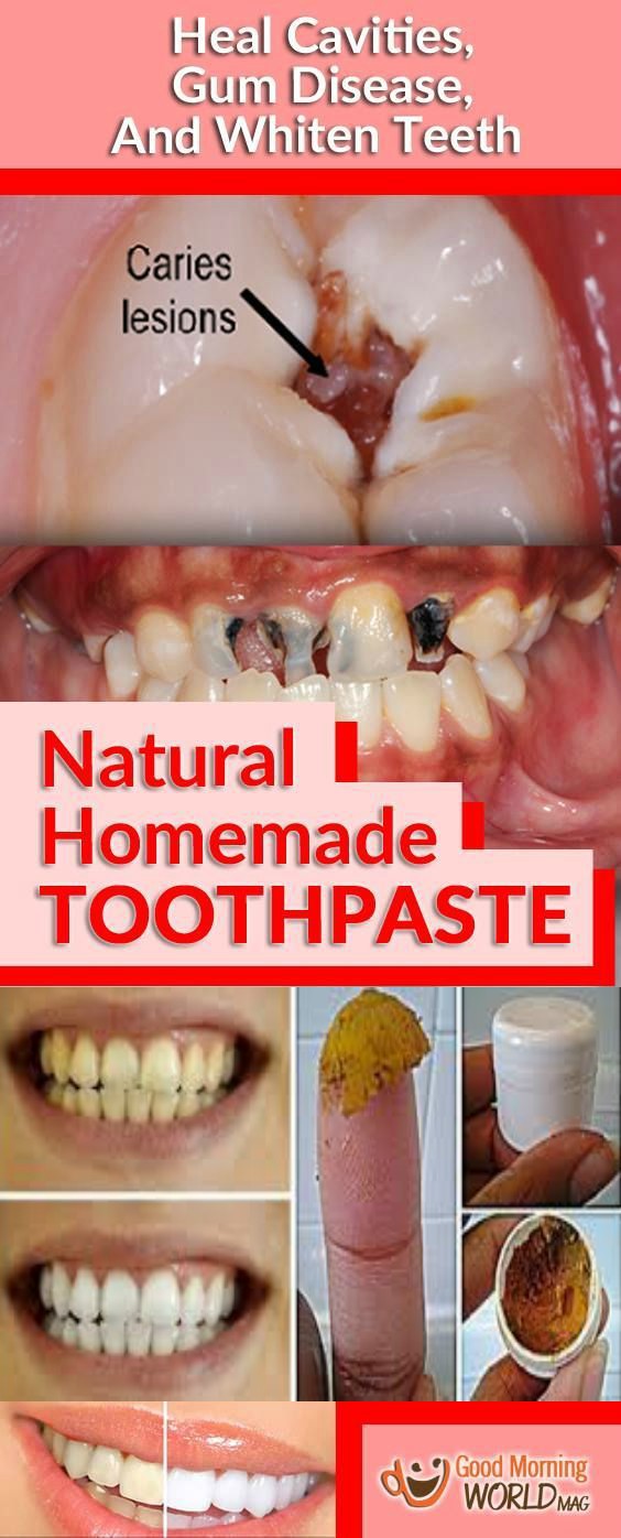 Heal Cavities, Gum Disease, And Whiten Teeth With This Natural Homemade Toothpaste!