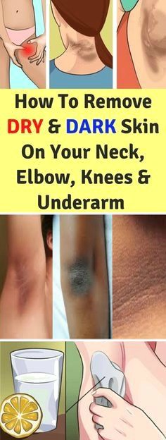 How To Remove Dry & Dark Skin On Your Neck, Elbows, Knees & Underarms!!!