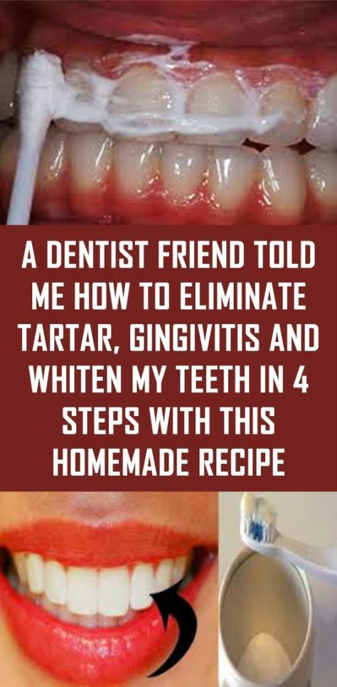 A Dentist Friend Told Me How To Eliminate Tartar, Gingivitis And Whiten My Teeth In 4 Steps With This Homemade Recipe